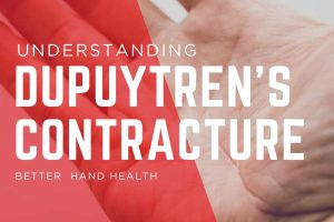A guide to dupuytren’s contracture